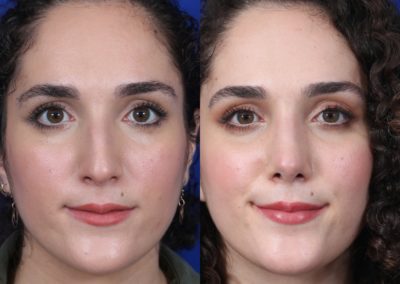 Female Closed Rhinoplasty Before and After