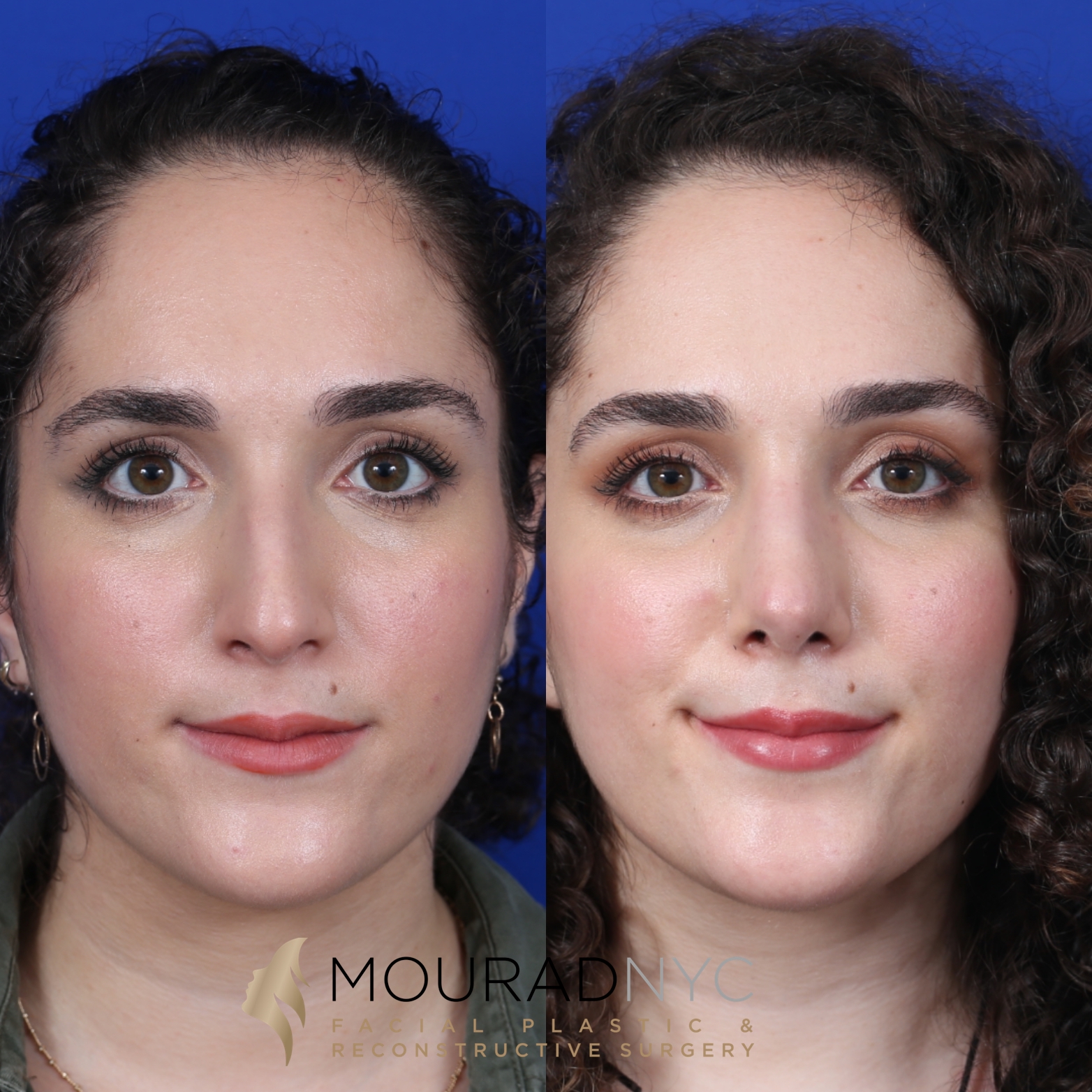 Female Closed Rhinoplasty Before and After