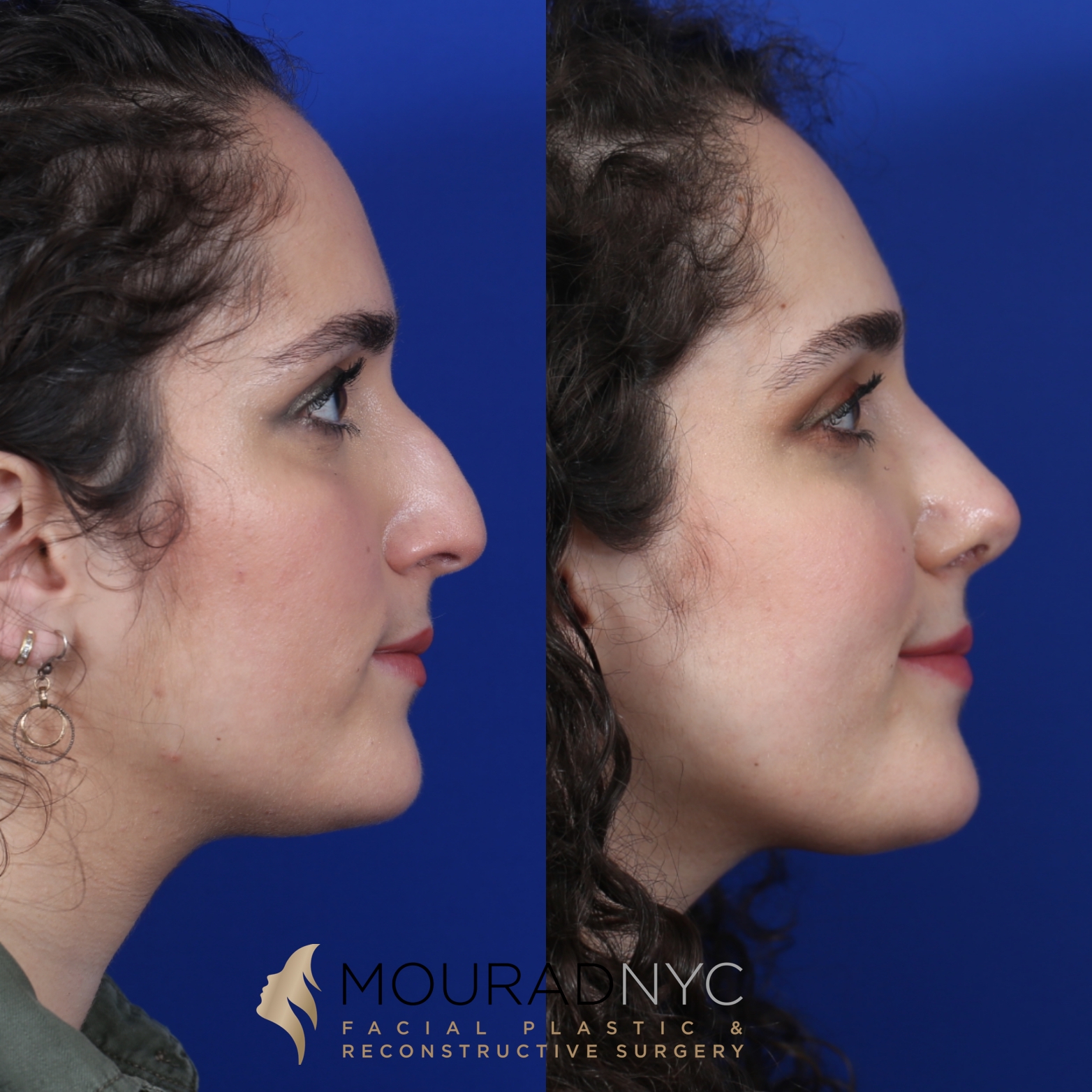 Female Closed Rhinoplasty Before and After