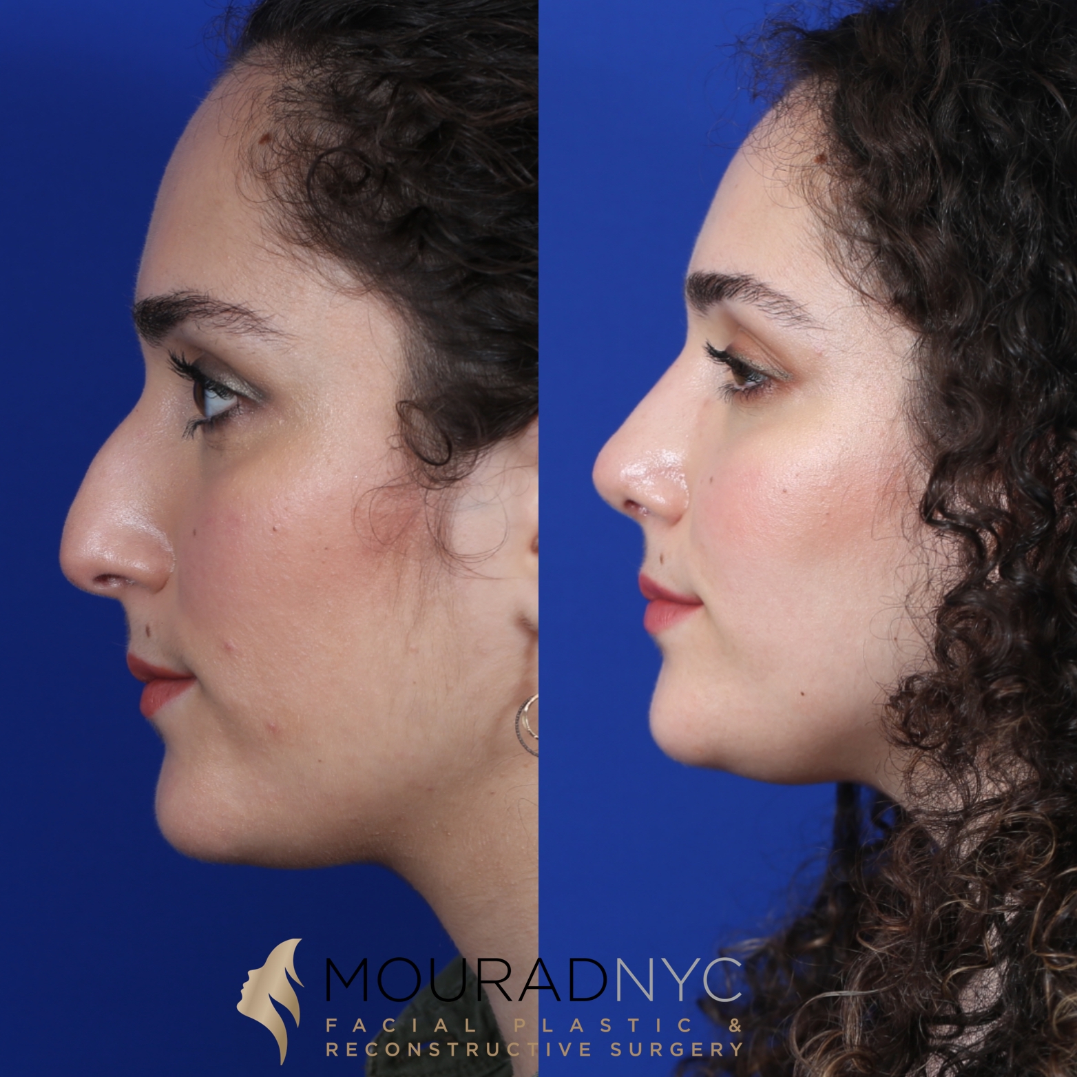 Female Closed Rhinoplasty Before and After