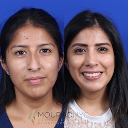 Female Open Rhinoplasty Before and After