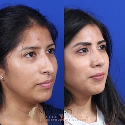 Female Open Rhinoplasty Before and After Female Open Rhinoplasty Before and After
