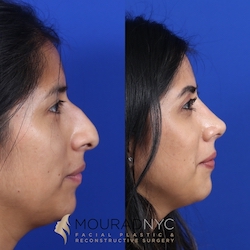 Female Open Rhinoplasty Before and After Female Open Rhinoplasty Before and After