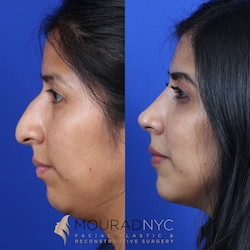 Female Open Rhinoplasty Before and After Female Open Rhinoplasty Before and After
