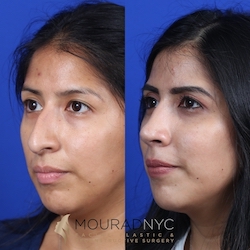 Female Open Rhinoplasty Before and After Female Open Rhinoplasty Before and After