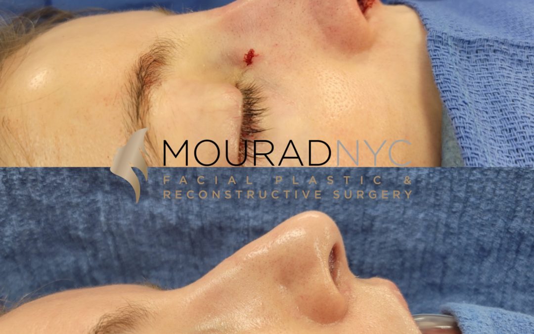 Female Revision Rhinoplasty Before and After