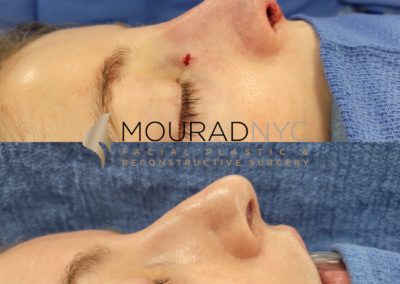 Female Revision Rhinoplasty Before and After