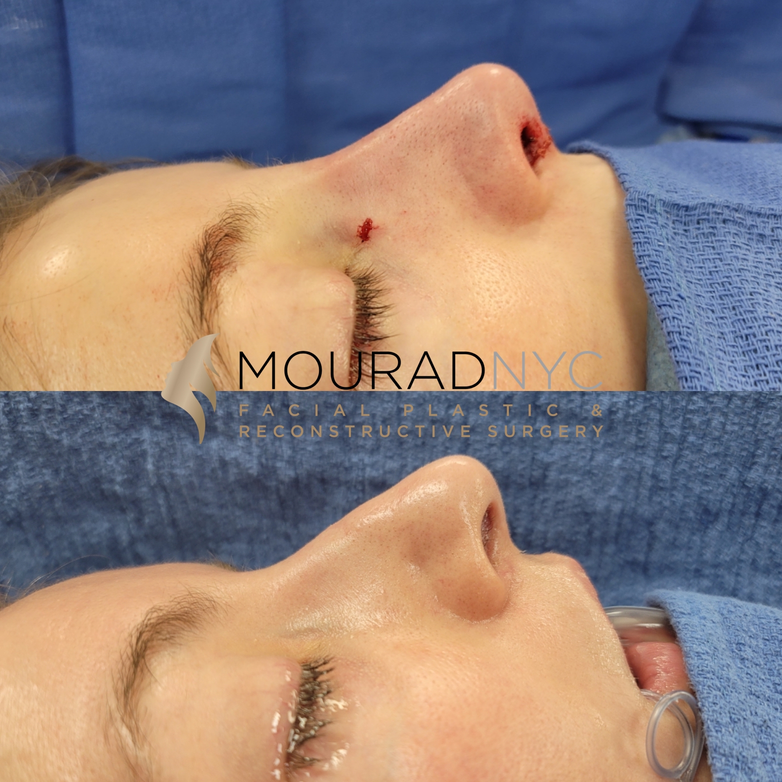 Female Revision Rhinoplasty Before and After Female Revision Rhinoplasty Before and After
