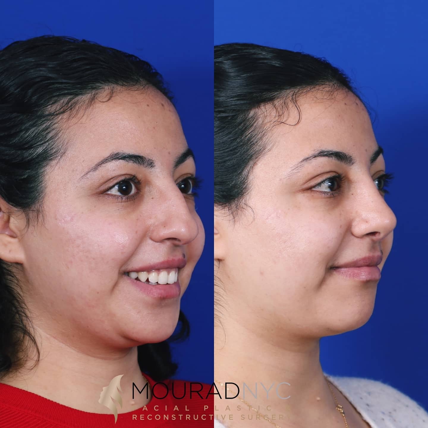 Ethnic Rhinoplasty Before and After Ethnic Rhinoplasty Before and After