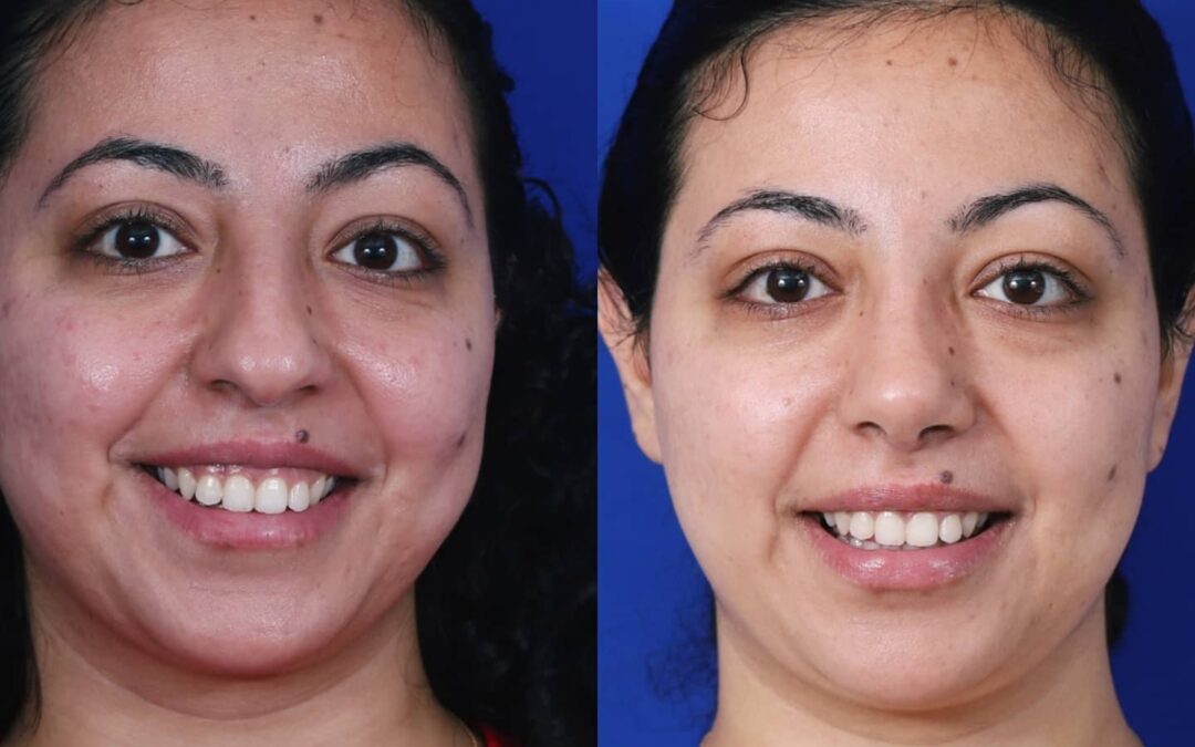 Ethnic Rhinoplasty Before and After