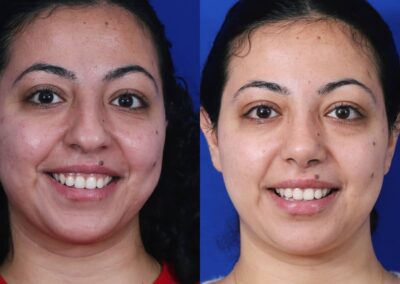 Ethnic Rhinoplasty Before and After