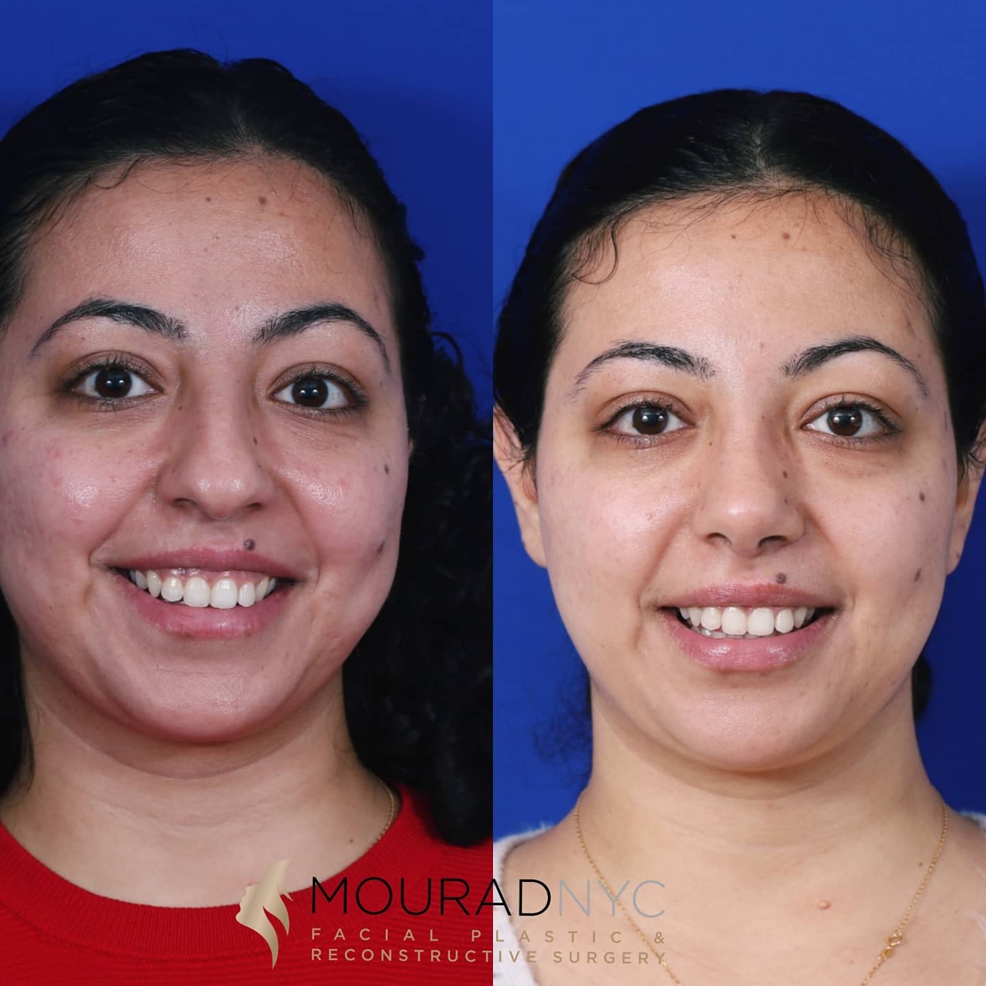 Ethnic Rhinoplasty Before and After Ethnic Rhinoplasty Before and After