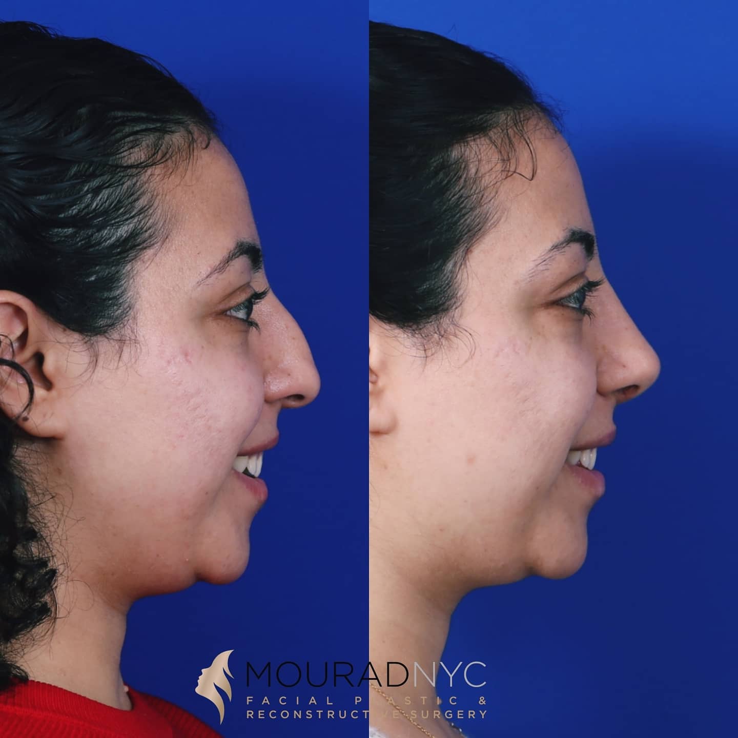 Ethnic Rhinoplasty Before and After Ethnic Rhinoplasty Before and After
