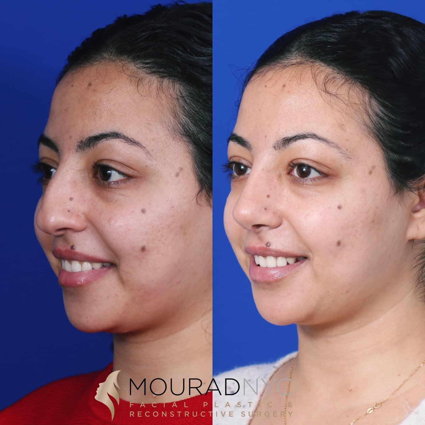 Ethnic Rhinoplasty Before and After Ethnic Rhinoplasty Before and After