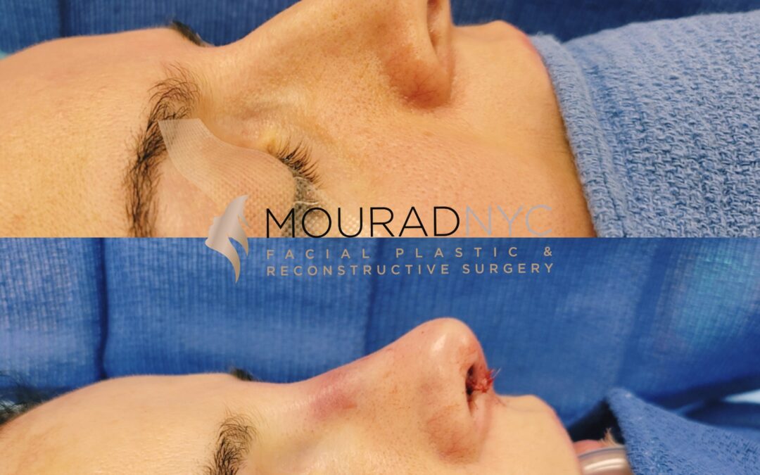 Female Revision Rhinoplasty