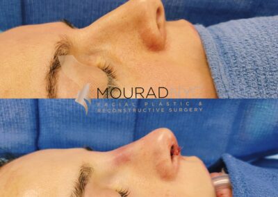 Female Revision Rhinoplasty
