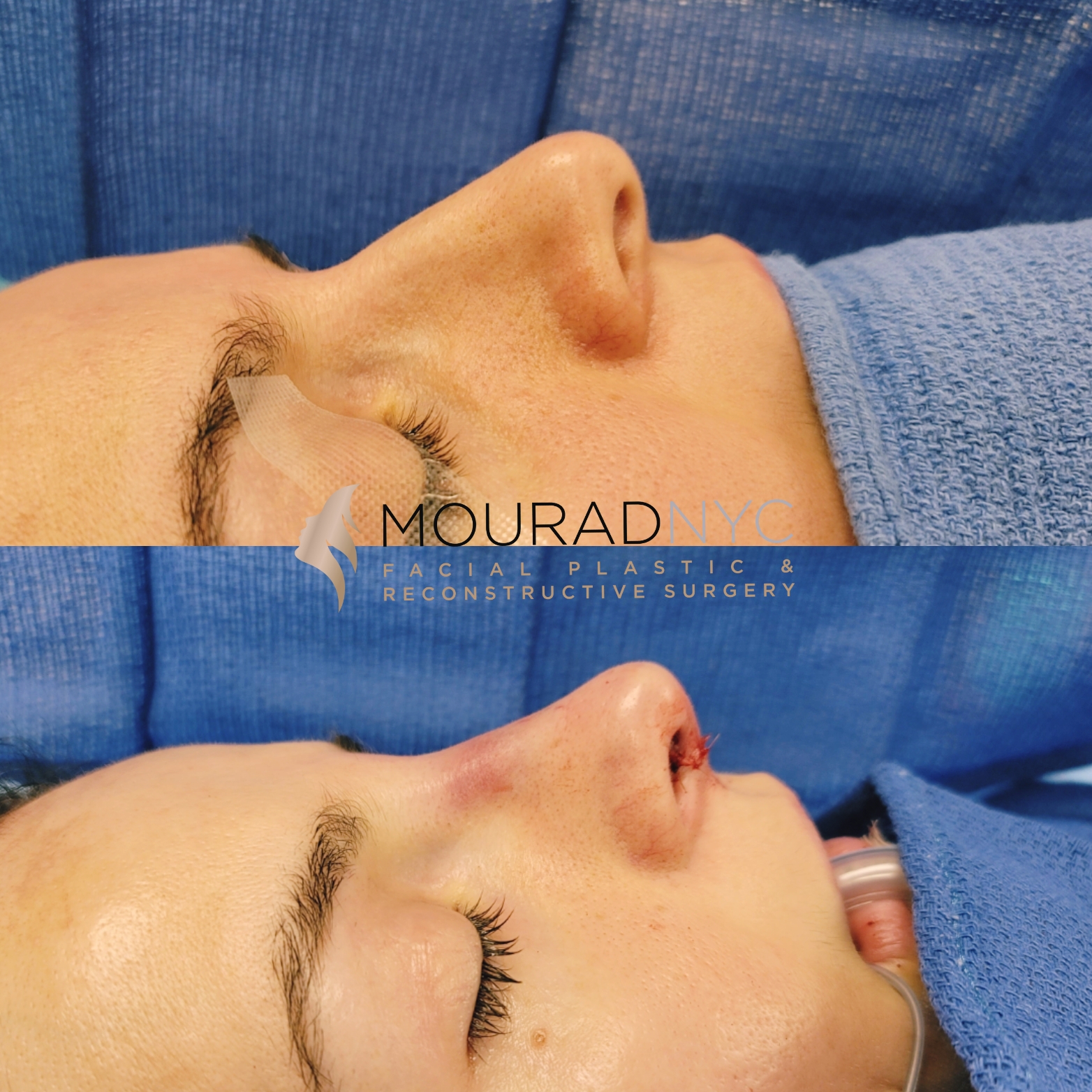 Female Revision Rhinoplasty Female Revision Rhinoplasty