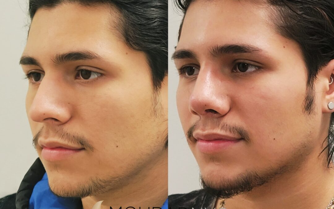 Male Rhinoplasty Before and After