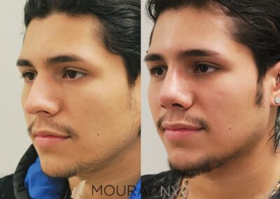 Male Rhinoplasty Before and After