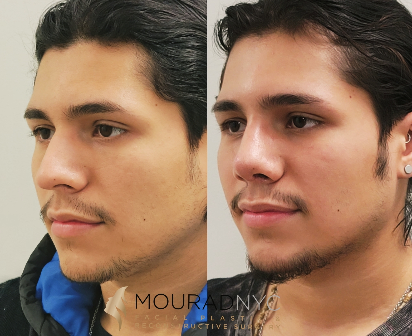 Male Rhinoplasty Before and After Male Rhinoplasty Before and After