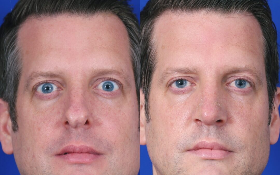 Rhinoplasty and Otoplasty
