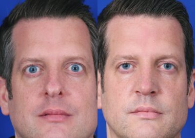 Rhinoplasty and Otoplasty