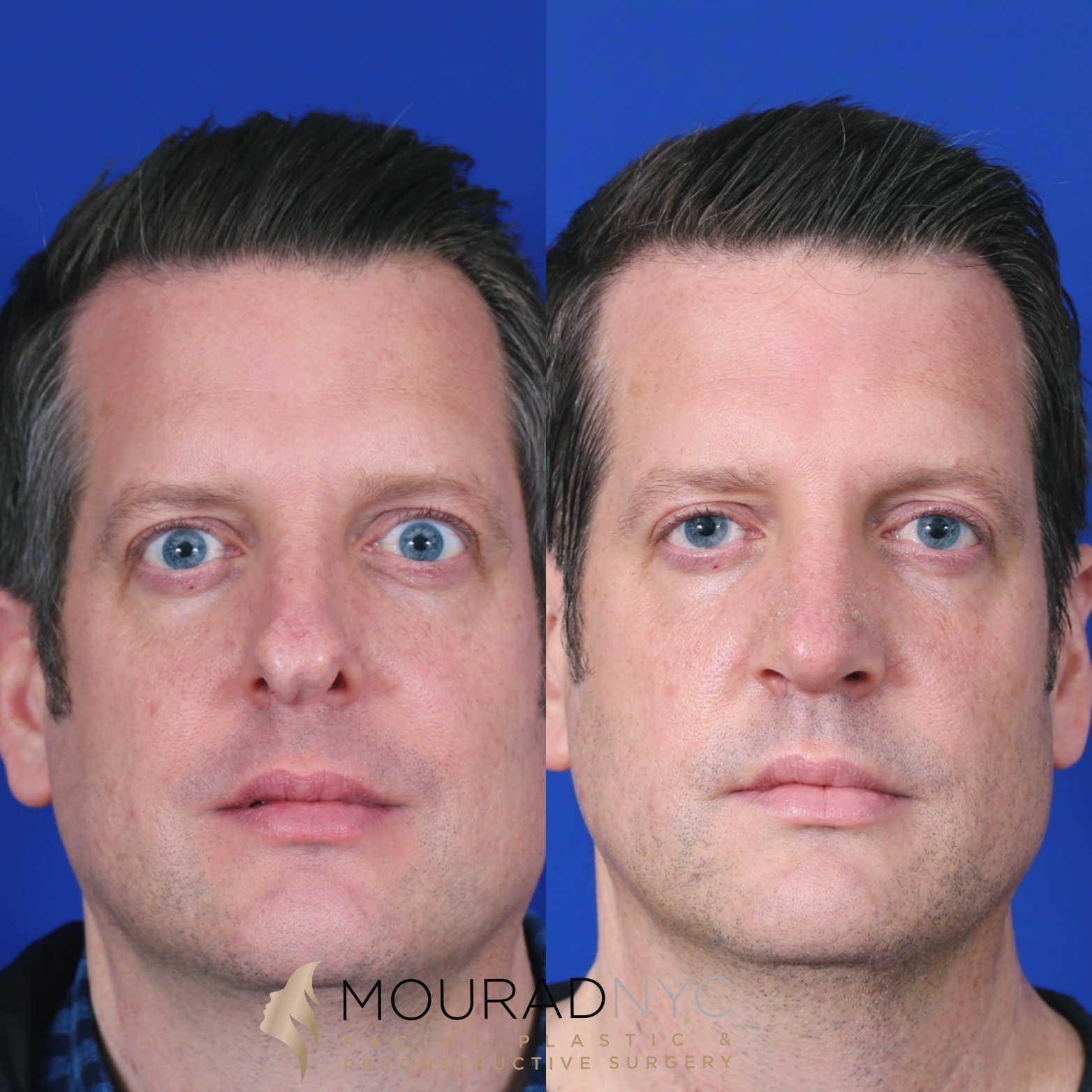 Rhinoplasty and Otoplasty Rhinoplasty and Otoplasty