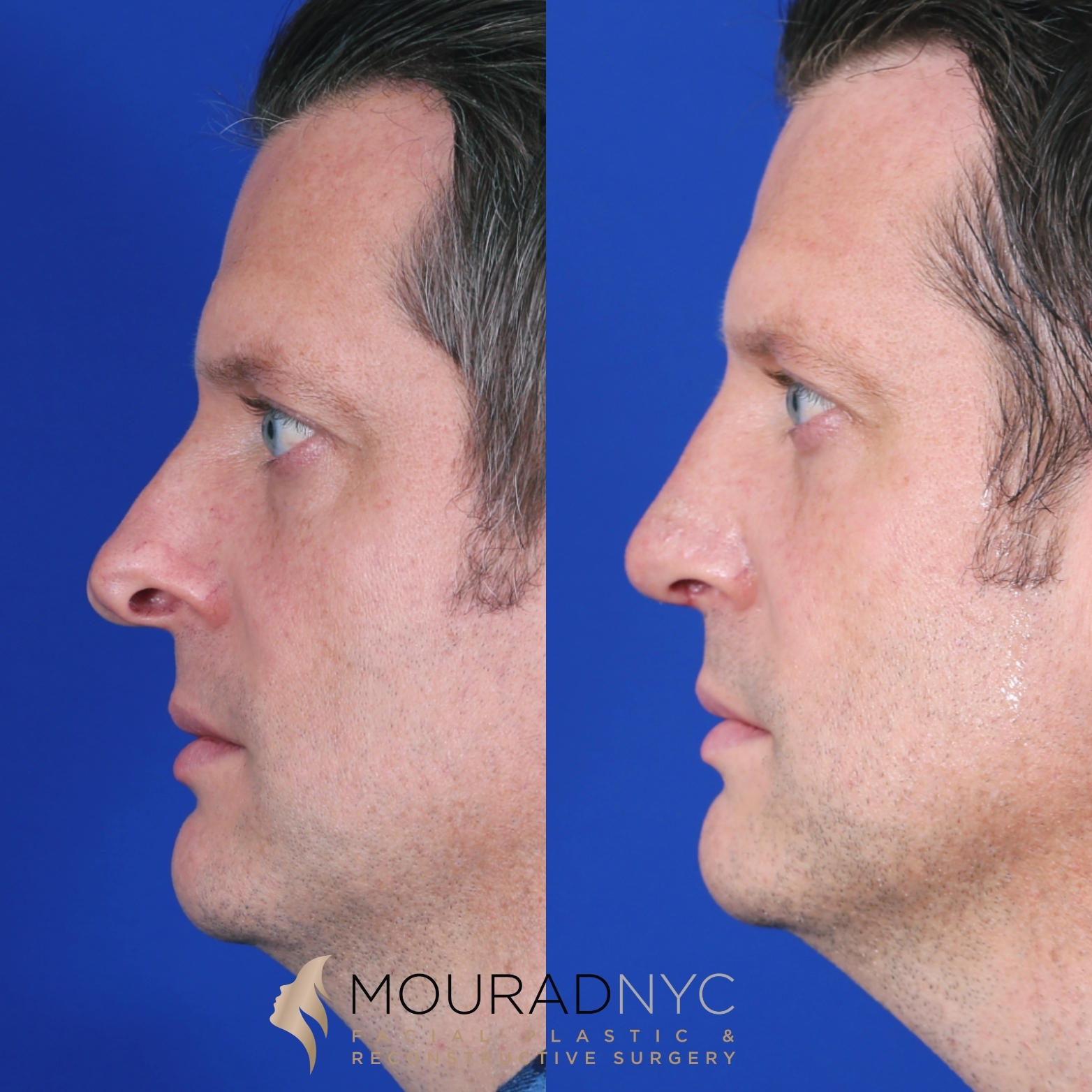 Rhinoplasty and Otoplasty Rhinoplasty and Otoplasty