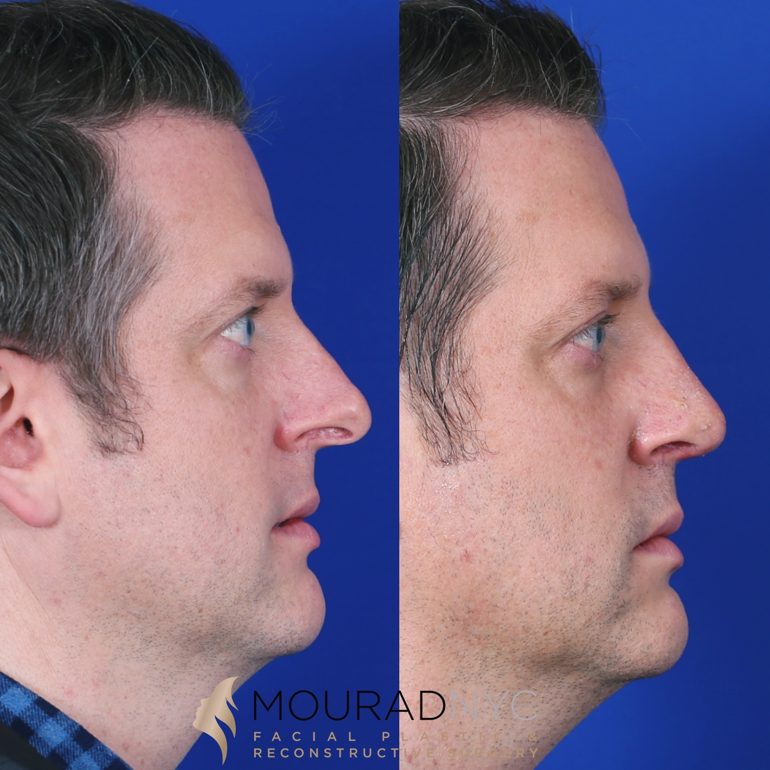 Rhinoplasty and Otoplasty Rhinoplasty and Otoplasty