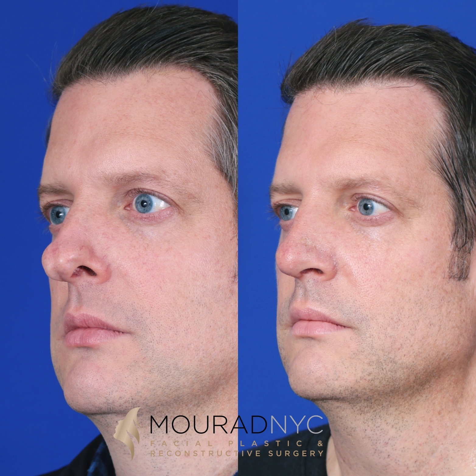 Rhinoplasty and Otoplasty Rhinoplasty and Otoplasty