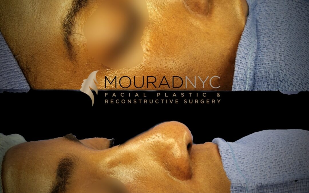 Before and After Ethnic Rhinoplasty