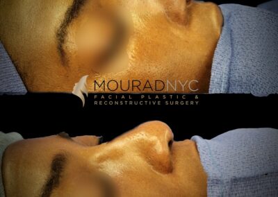 Before and After Ethnic Rhinoplasty