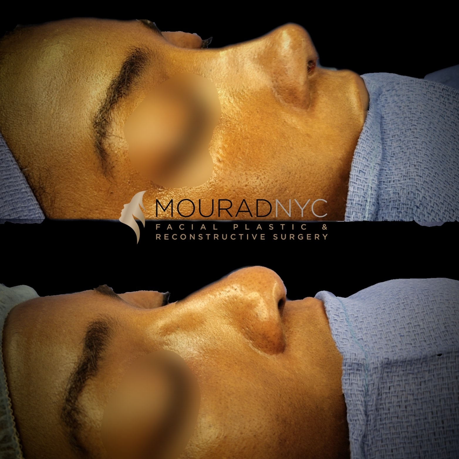Before and After Ethnic Rhinoplasty Before and After Ethnic Rhinoplasty