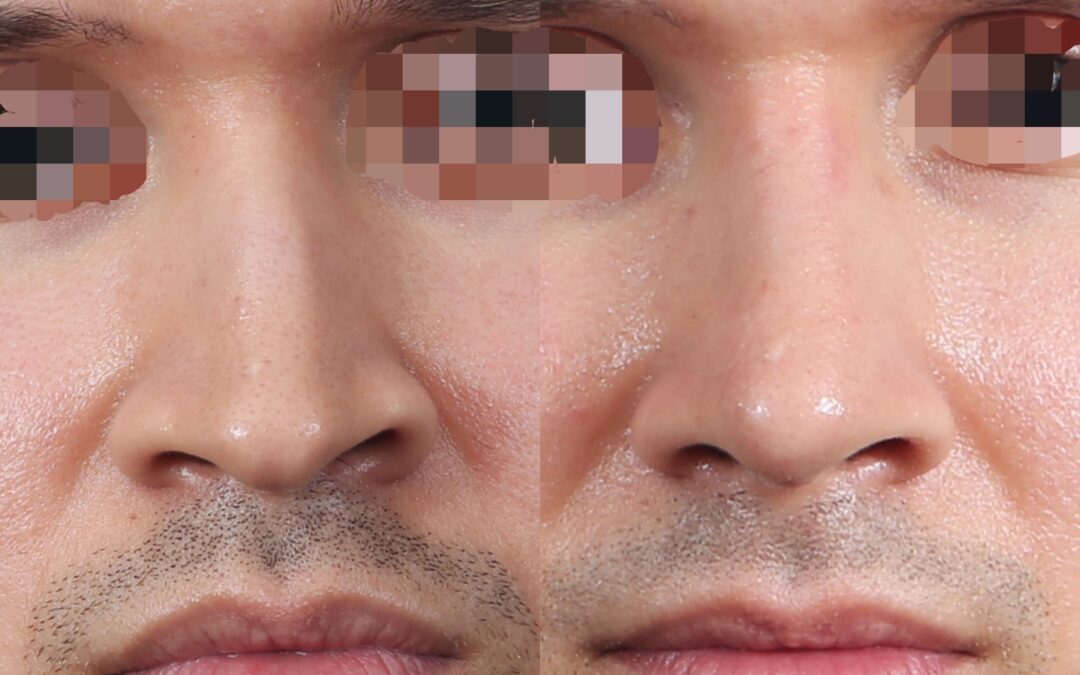 Before and After
