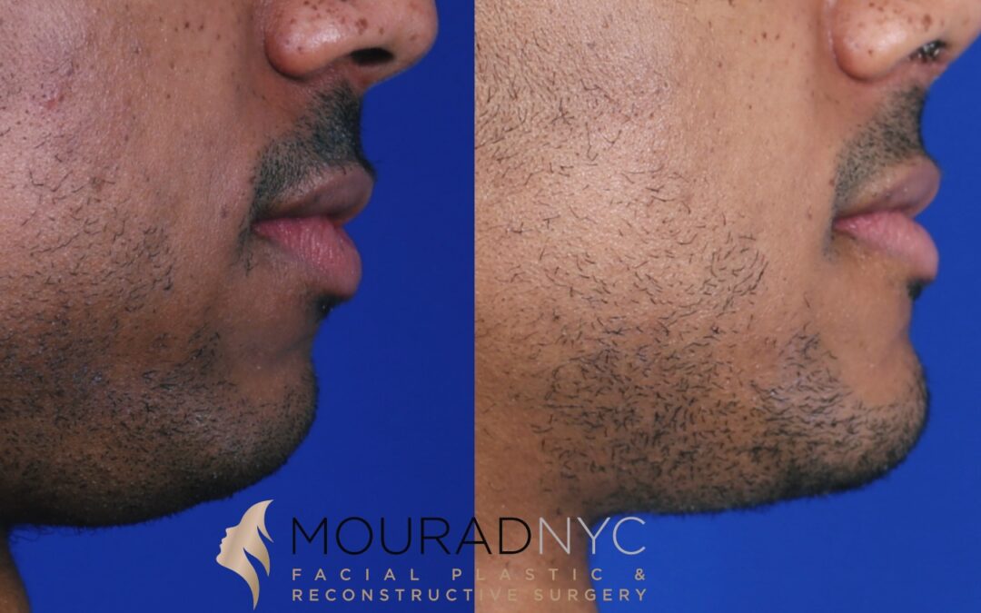 Sliding Genioplasty Before and After