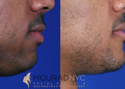 Sliding Genioplasty Before and After