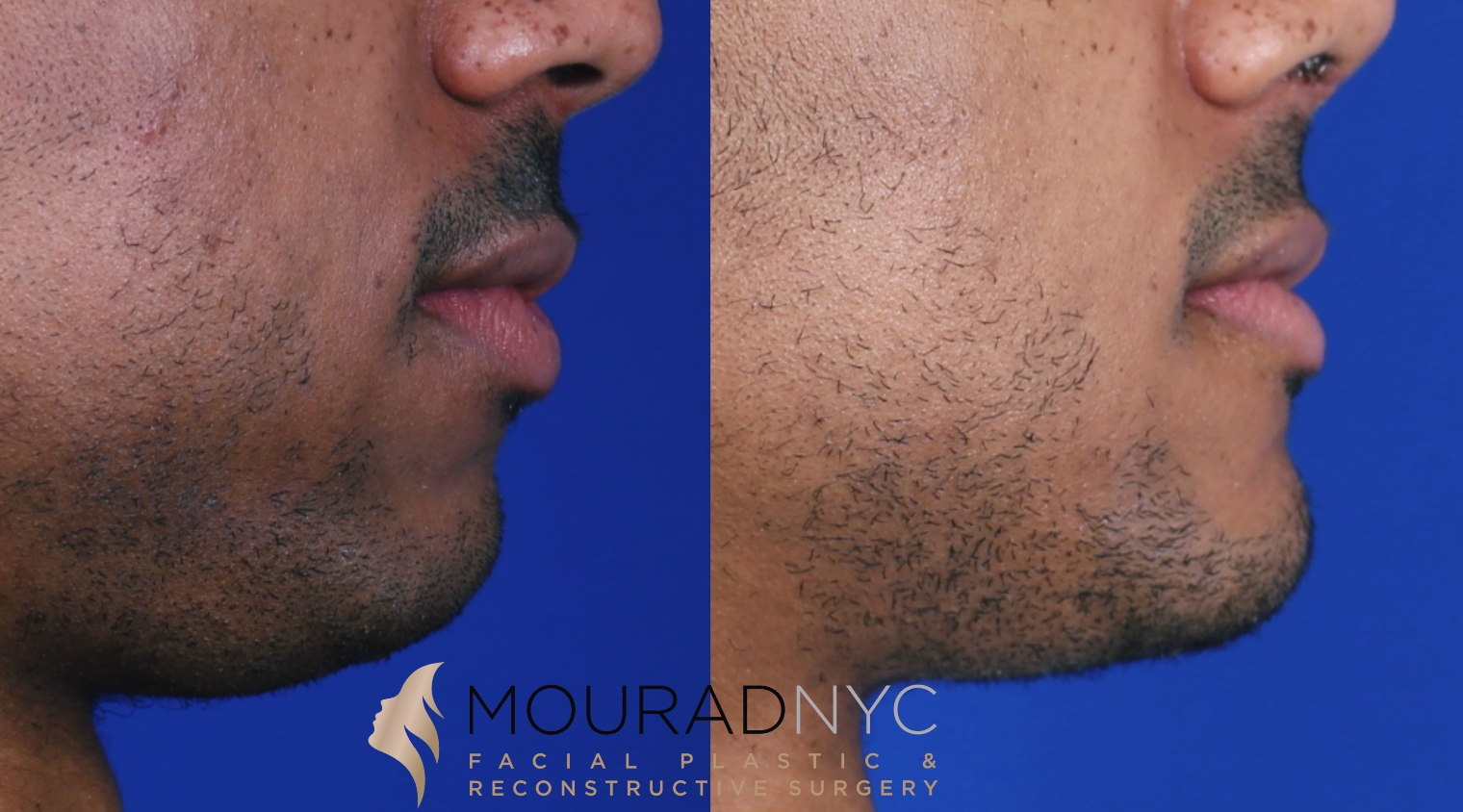 Sliding Genioplasty Before and After