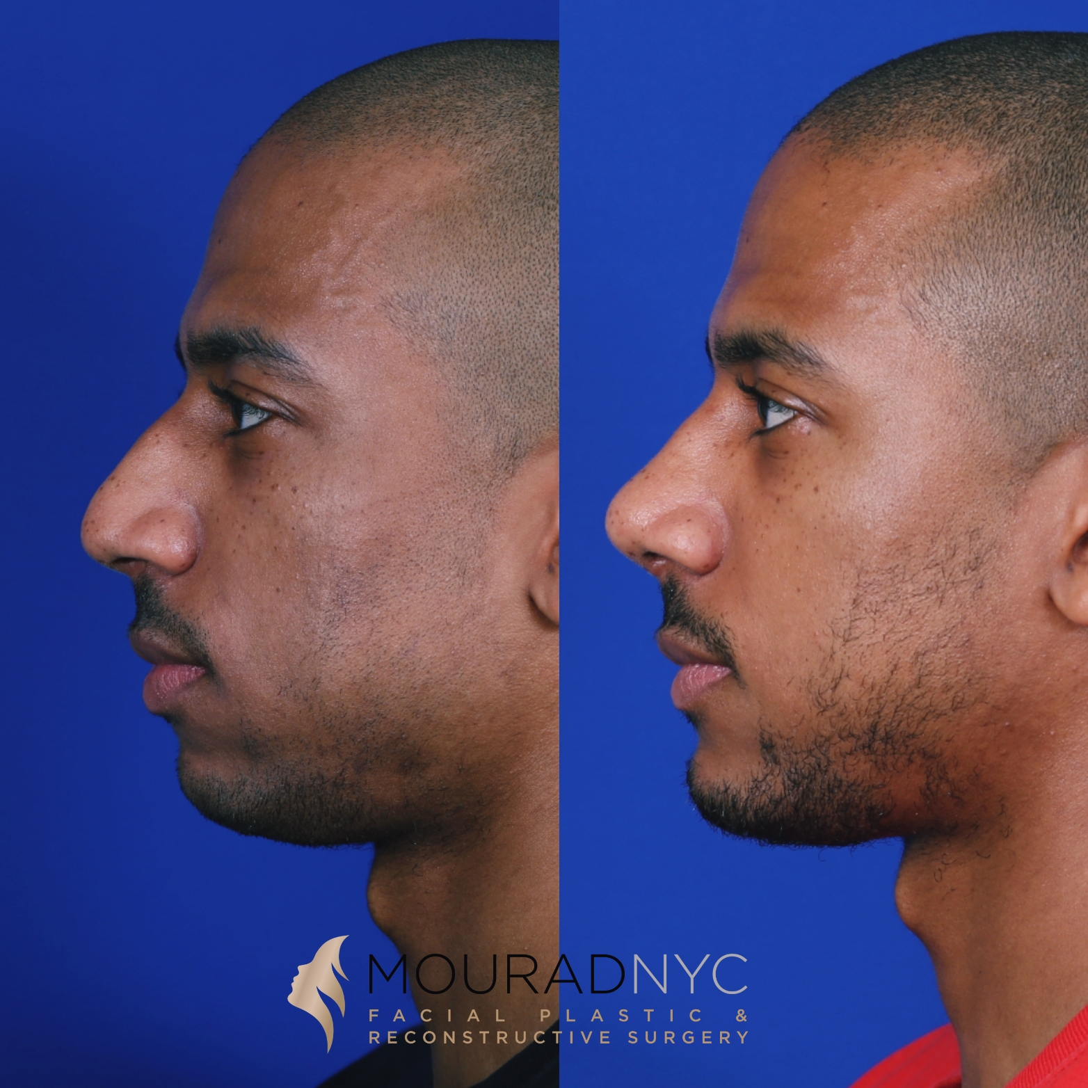 Sliding Genioplasty Before and After