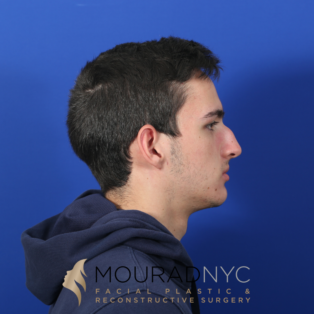 Before and After Rhinoplasty Male Before and After Rhinoplasty Male