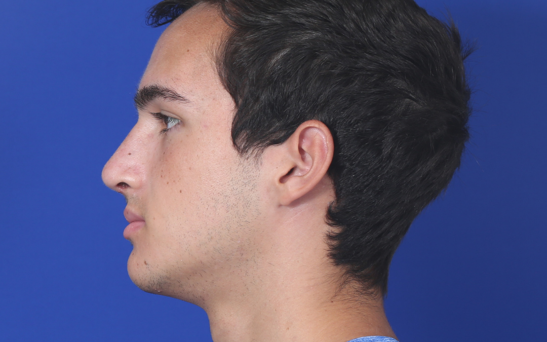Before and After Rhinoplasty Male