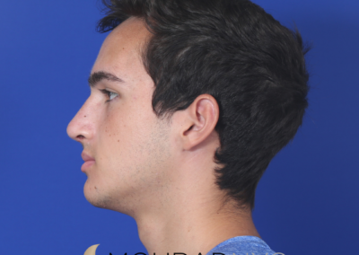 Before and After Rhinoplasty Male
