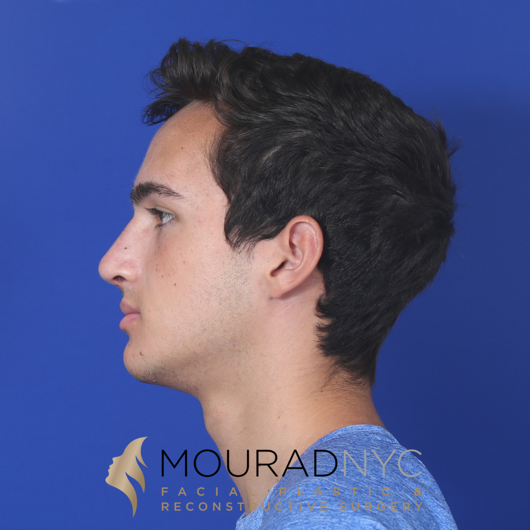 Before and After Rhinoplasty Male Before and After Rhinoplasty Male