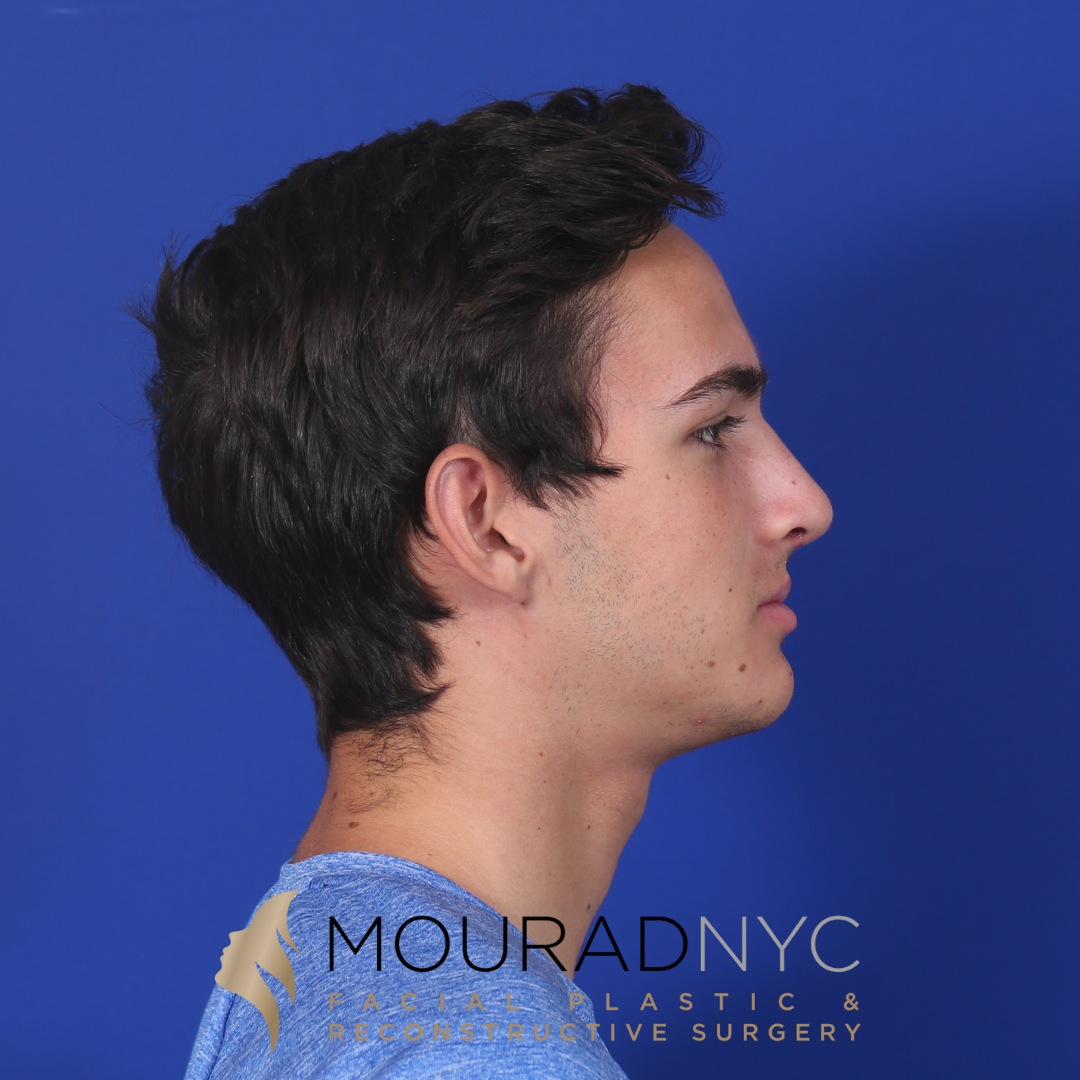 Before and After Rhinoplasty Male Before and After Rhinoplasty Male