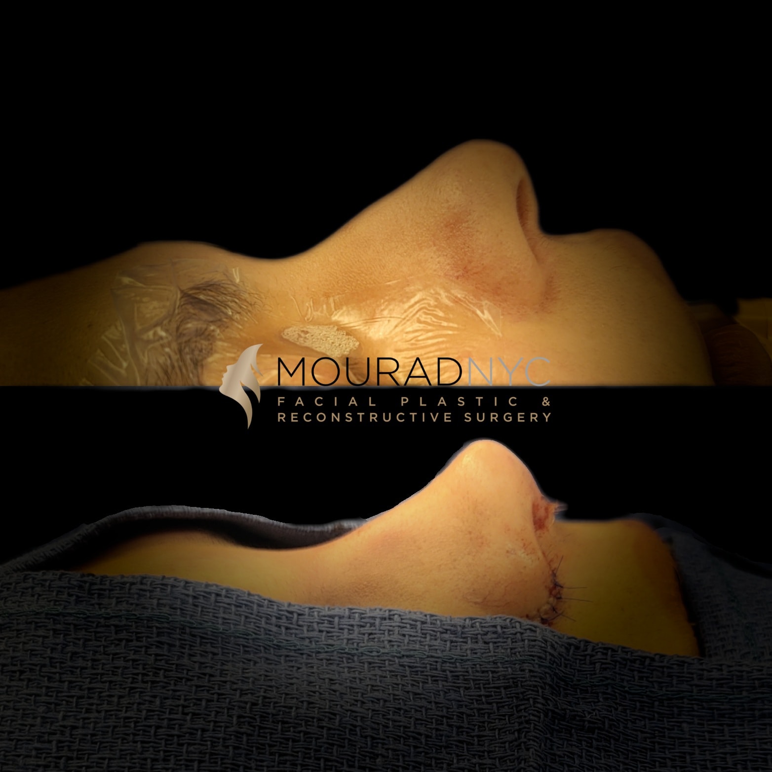 Rhinoplasty Before and After Rhinoplasty Before and After