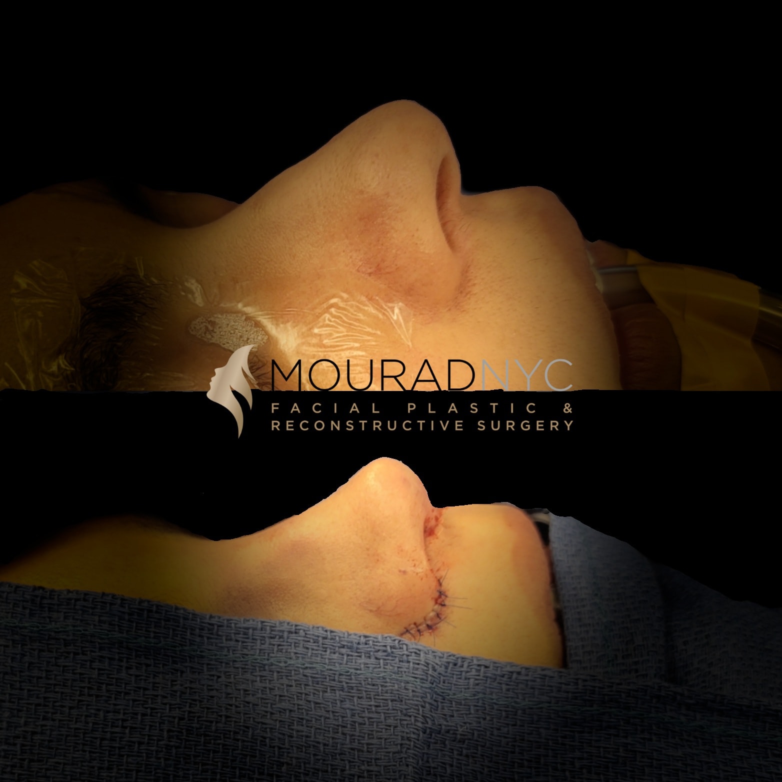 Rhinoplasty Before and After Rhinoplasty Before and After