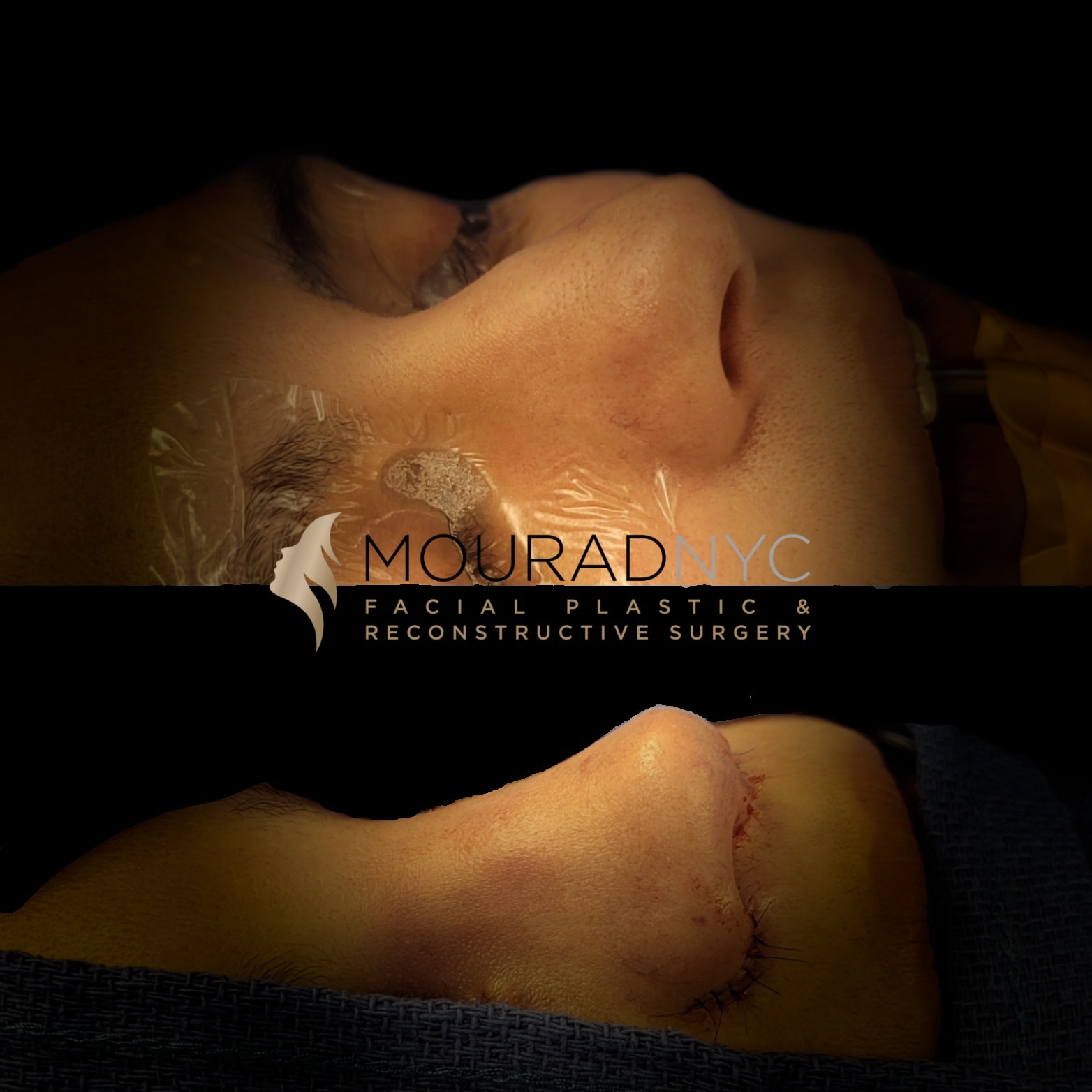 Rhinoplasty Before and After Rhinoplasty Before and After