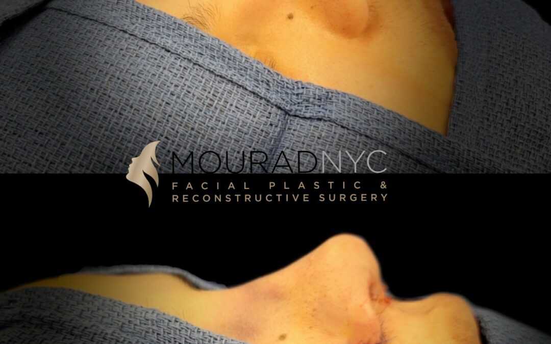 Before and After Rhinoplasty Female