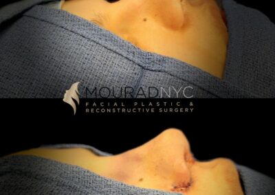 Before and After Rhinoplasty Female