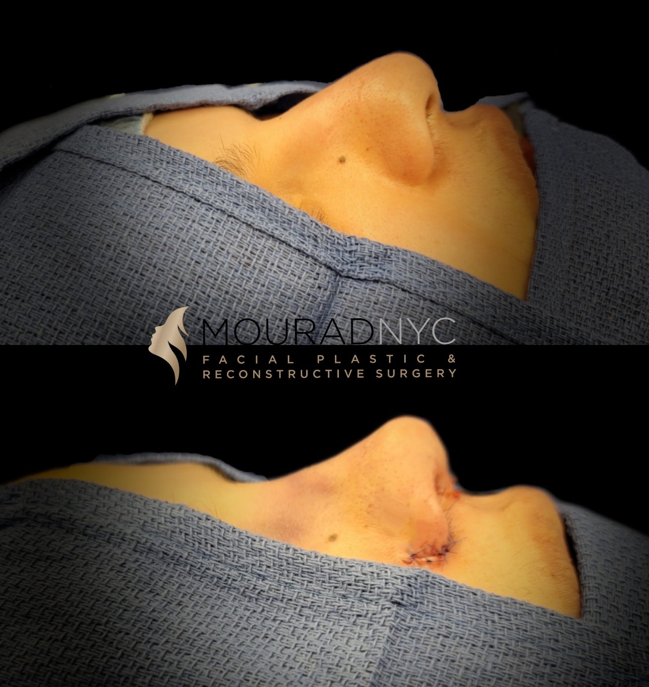 Before and After Rhinoplasty Female Before and After Rhinoplasty Female