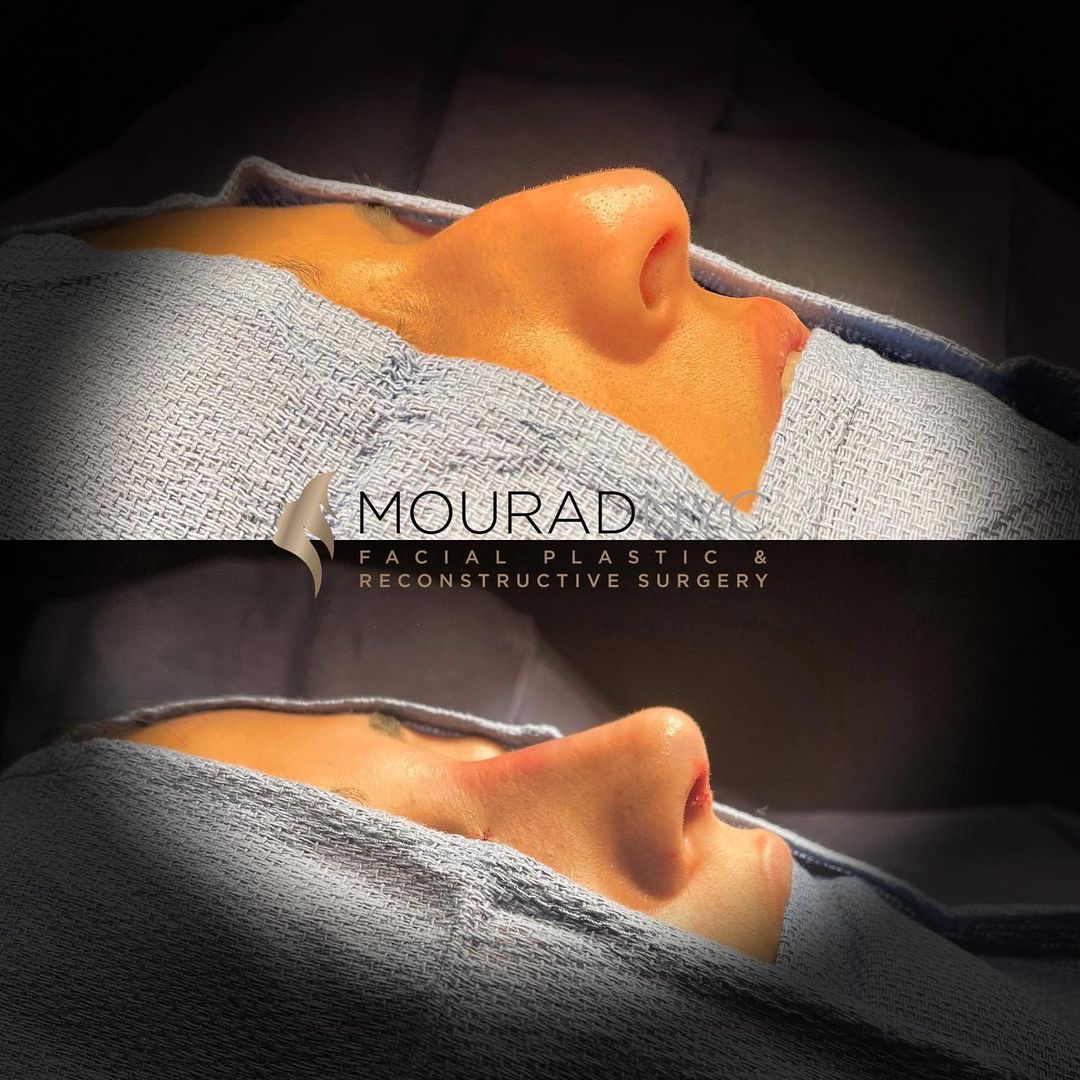 Rhinoplasty Before and After Female Rhinoplasty Before and After Female